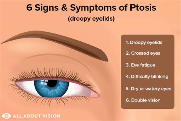 How do you know if you have droopy eyelids?