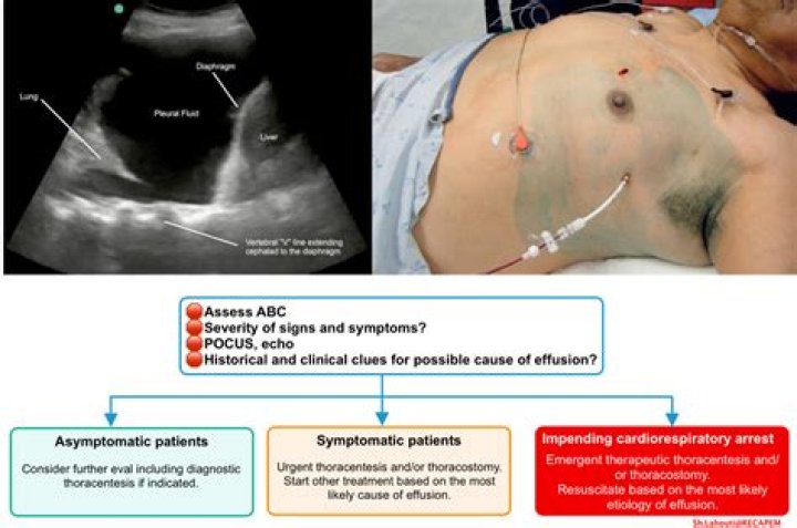 How long can you live after a bowel resection?