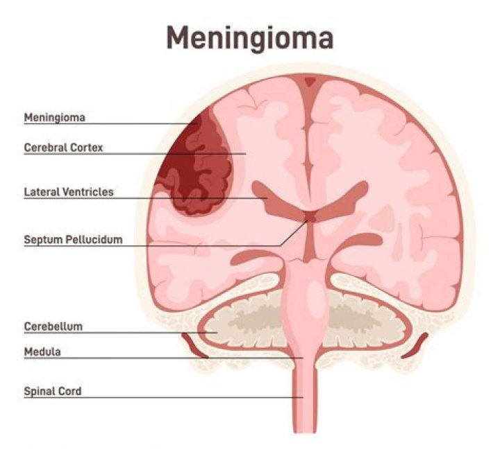 What is ICD 10 for meningiomas?