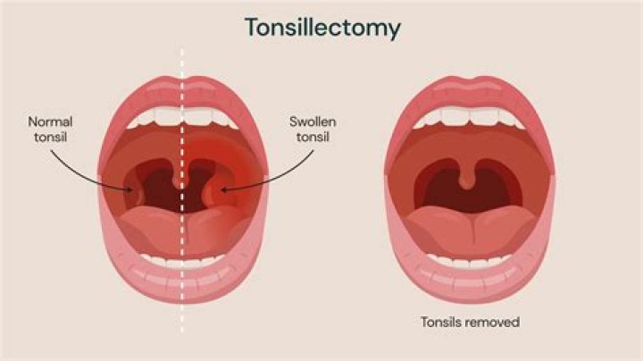 Why tonsillectomy is done?